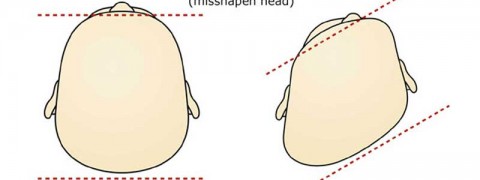 Head Asymmetry or Plagiocephaly